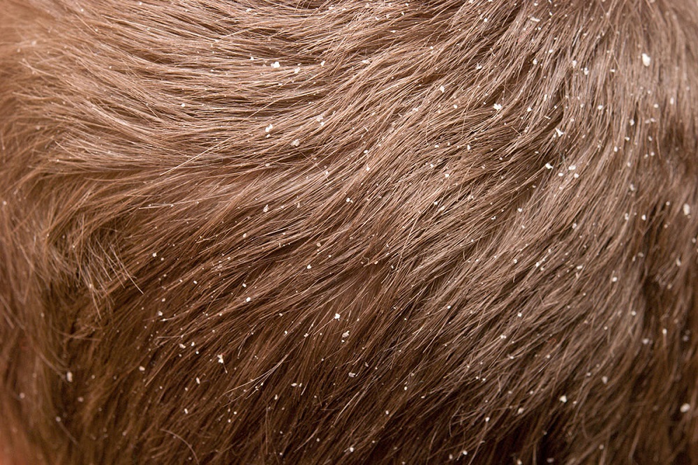 القشرة الشعر بسبب جفاف فرة الرأس